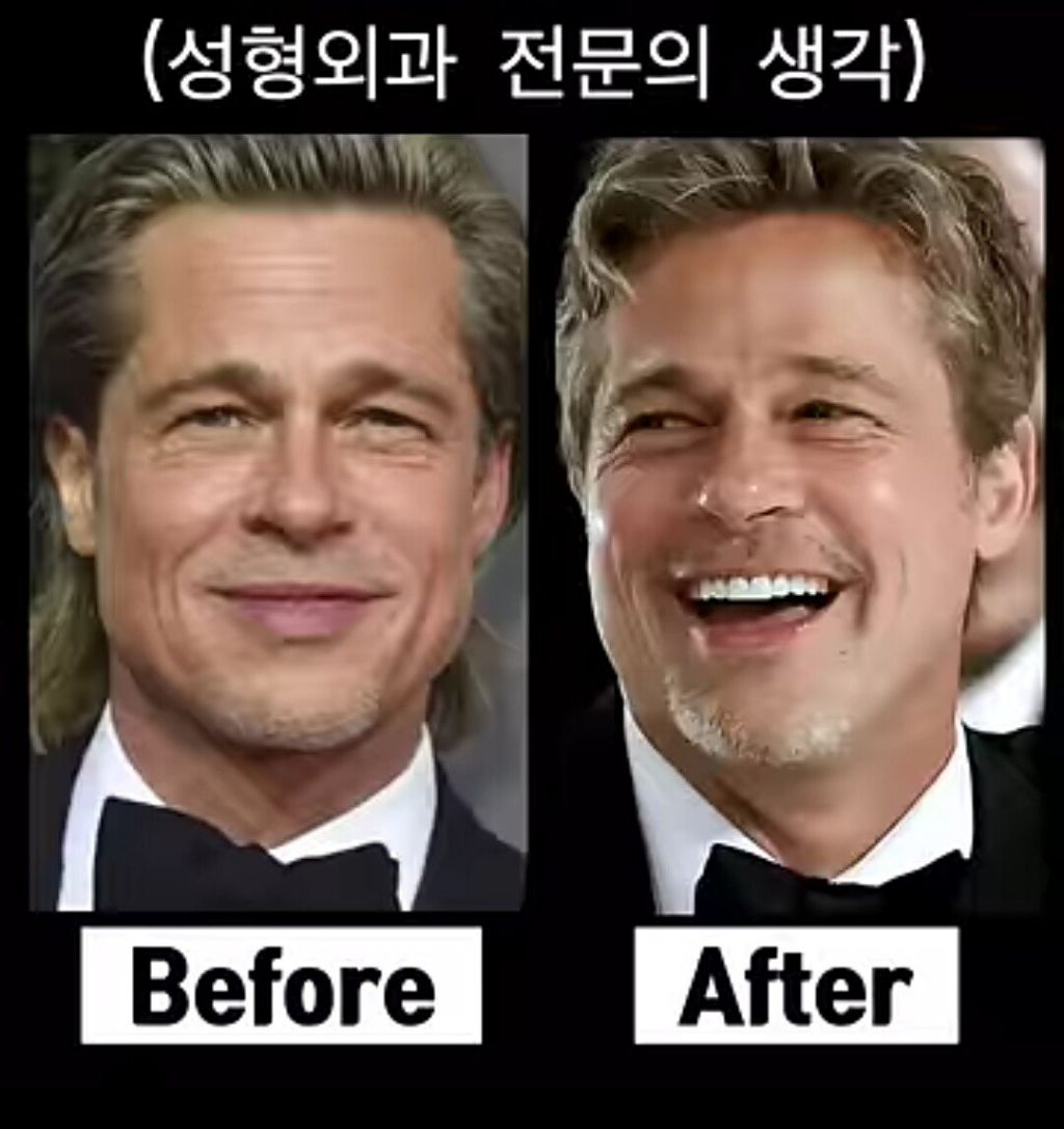 성형외과 의사도 극찬한 1억 6천짜리 성형 받았다는 브래드 피트